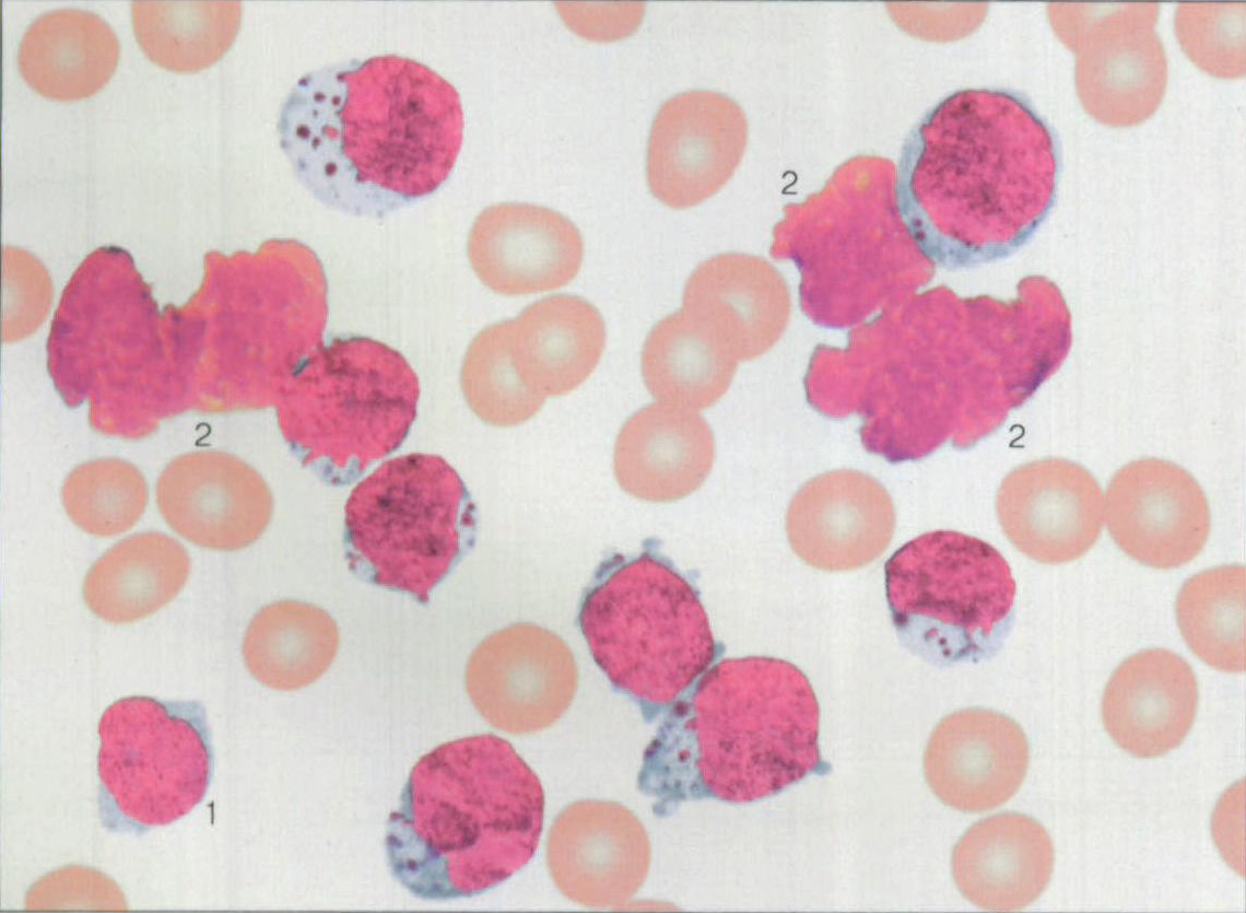 图173 颗粒性淋巴细胞白血病骨髓象